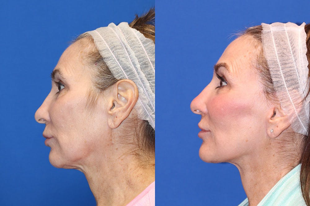 Neck Lift Before & After Gallery - Patient 71701795 - Image 1