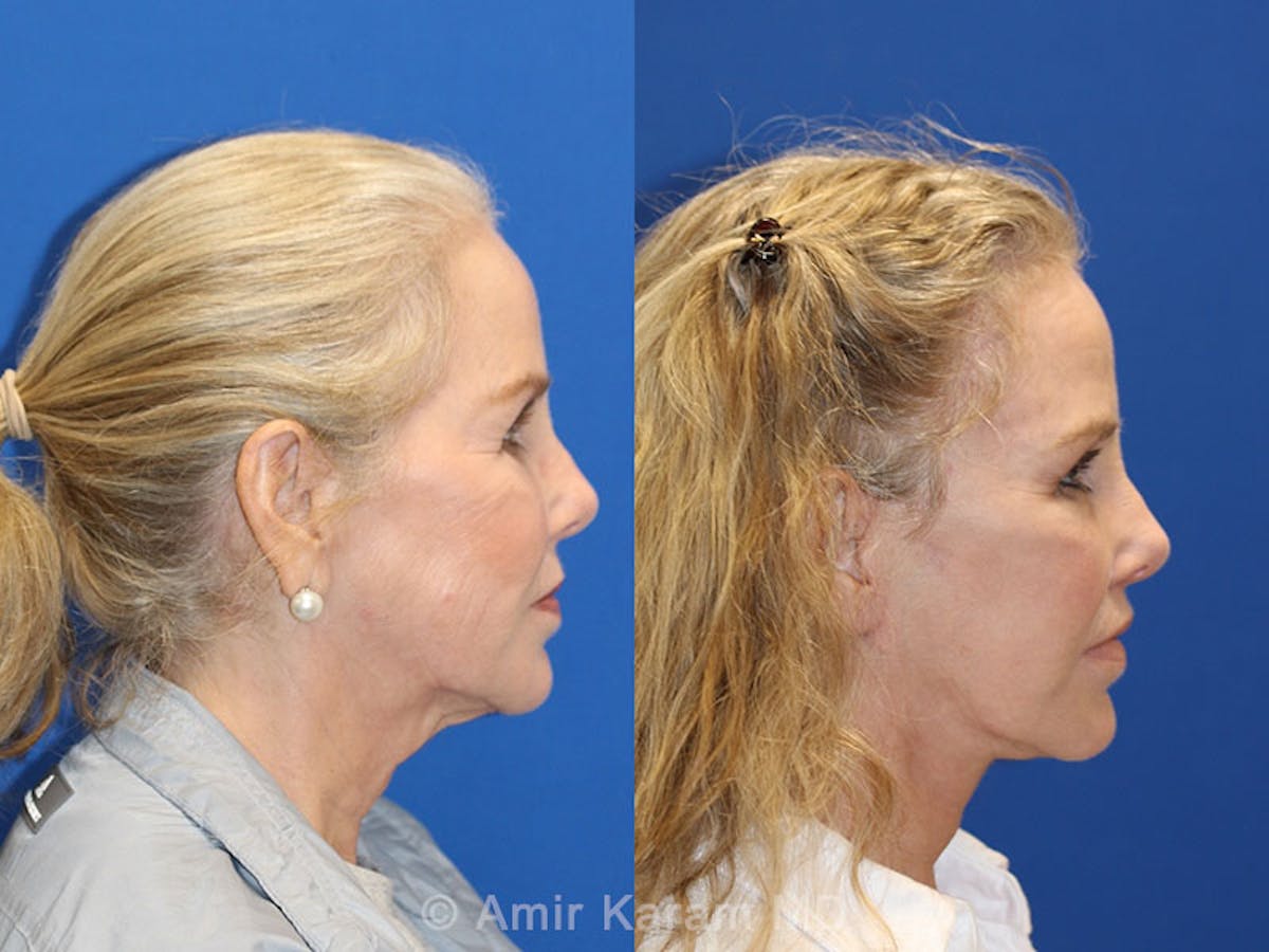 Laser Before & After Gallery - Patient 71701796 - Image 5