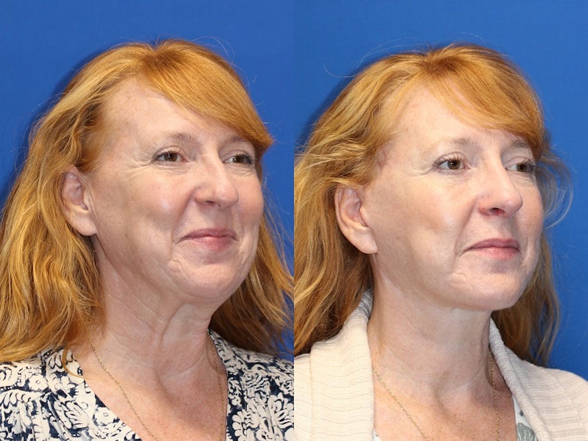 Neck Lift Before & After Gallery - Patient 71701803 - Image 4