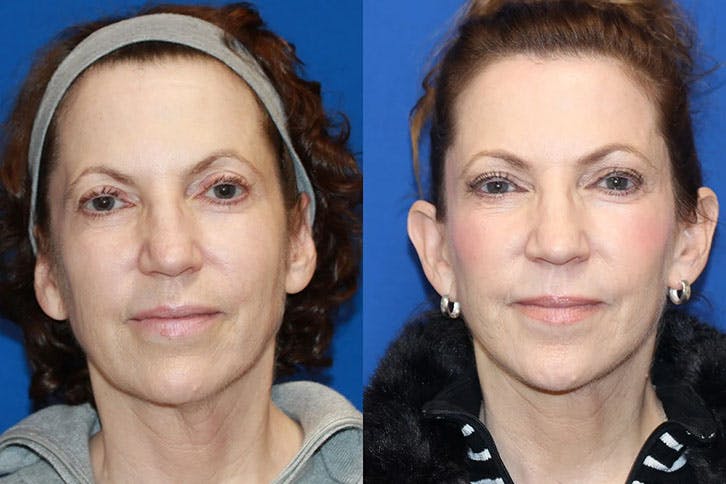 Laser Before & After Gallery - Patient 71701824 - Image 1