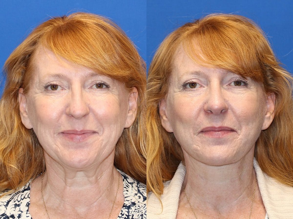 Neck Lift Before & After Gallery - Patient 71701803 - Image 5