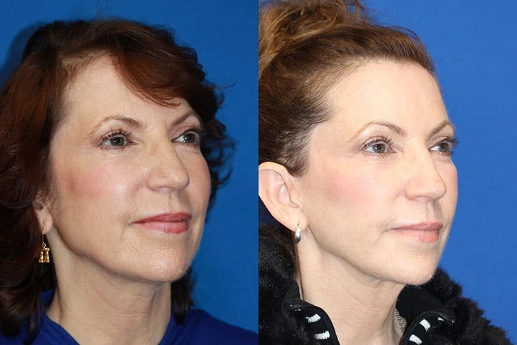 Laser Before & After Gallery - Patient 71701824 - Image 2