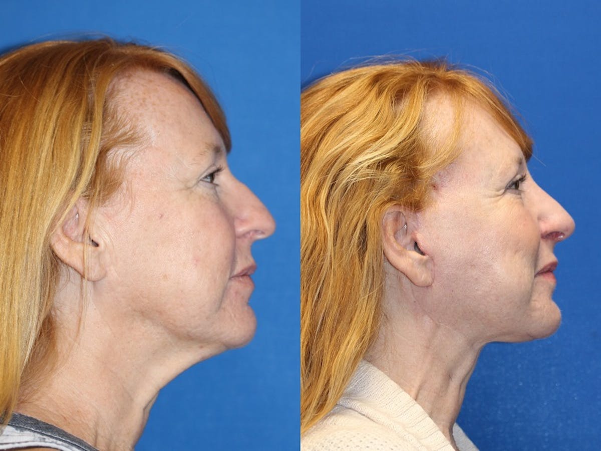 Neck Lift Before & After Gallery - Patient 71701803 - Image 3