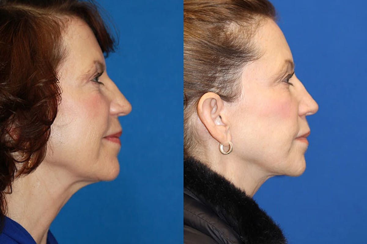 Laser Before & After Gallery - Patient 71701824 - Image 3