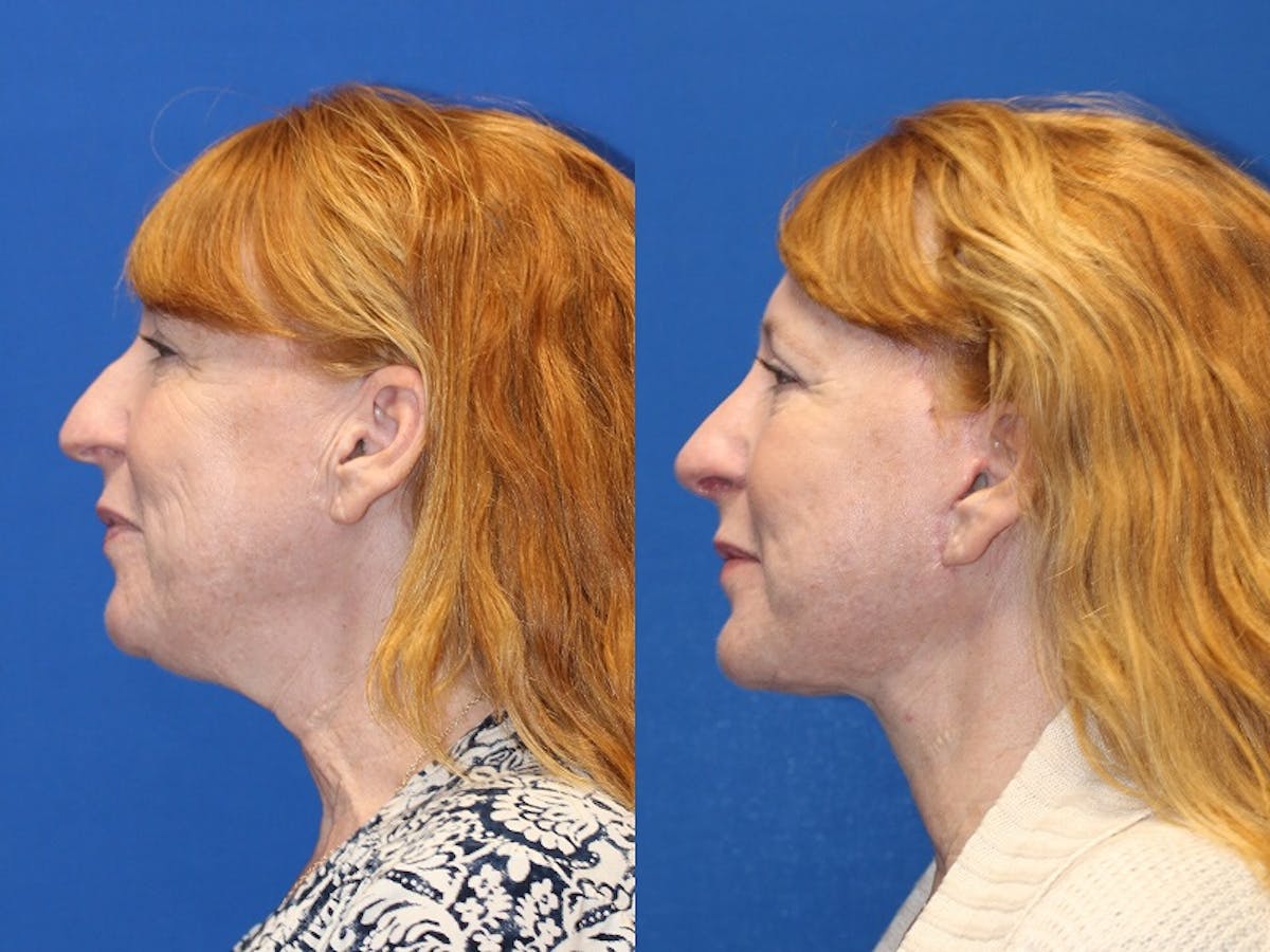 Neck Lift Before & After Gallery - Patient 71701803 - Image 1