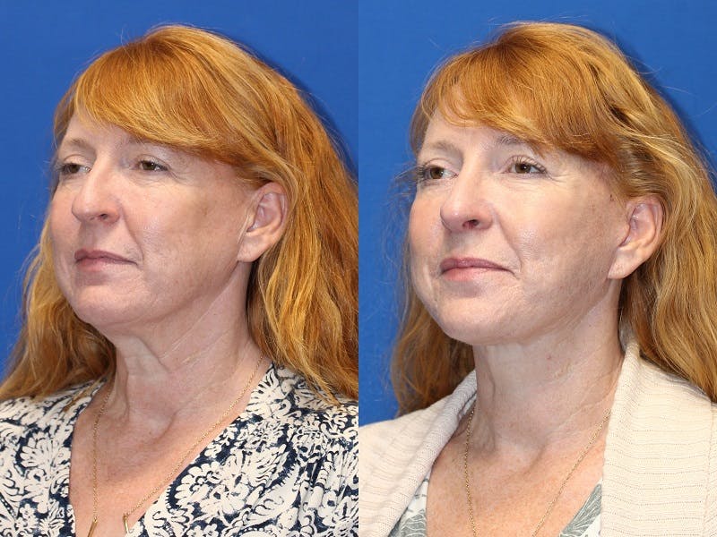 Neck Lift Before & After Gallery - Patient 71701803 - Image 2