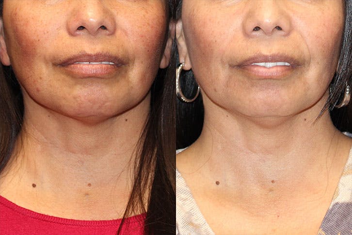Halo Laser Before & After Gallery - Patient 71701822 - Image 1