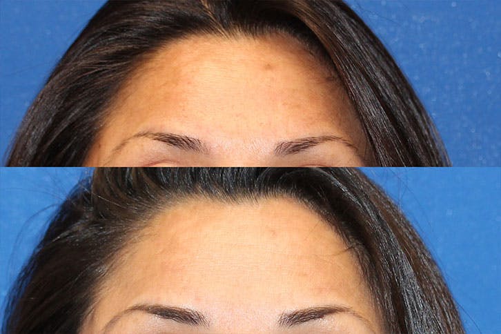 Halo Laser Before & After Gallery - Patient 71701822 - Image 2