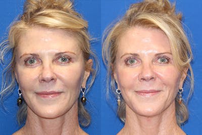 Halo Laser Before & After Gallery - Patient 71701823 - Image 1