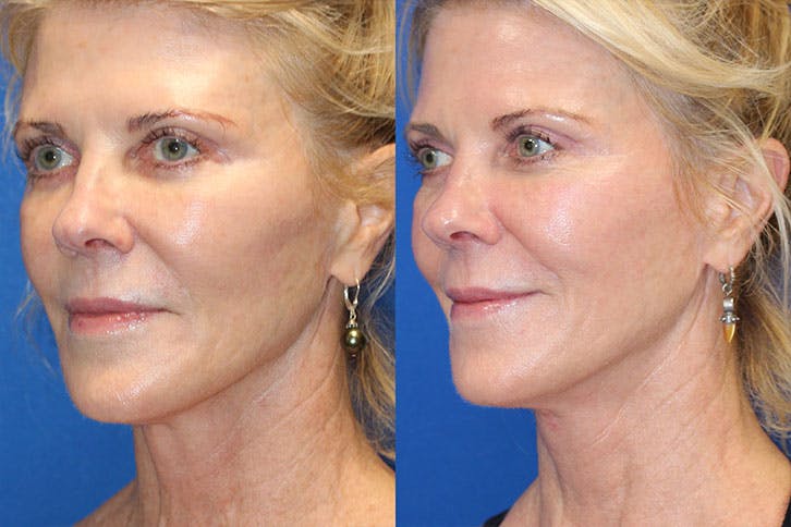 Halo Laser Before & After Gallery - Patient 71701823 - Image 2
