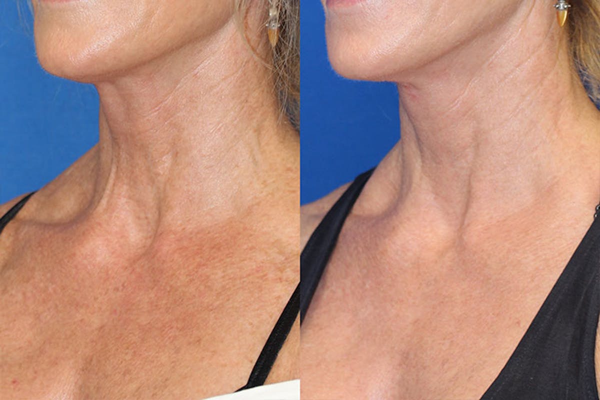 Halo Laser Before & After Gallery - Patient 71701823 - Image 3