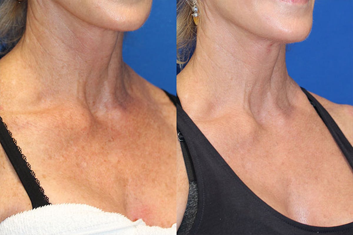 Halo Laser Before & After Gallery - Patient 71701823 - Image 4