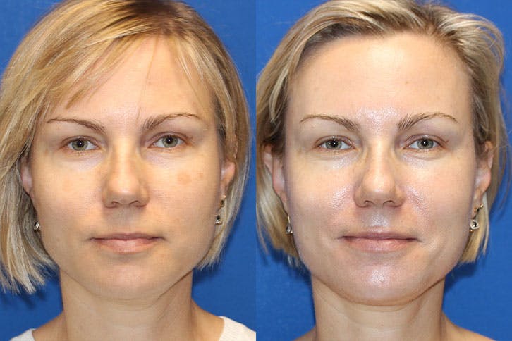 Halo Laser Before & After Gallery - Patient 71701825 - Image 1