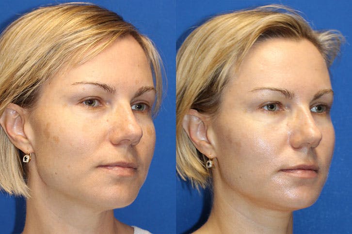 Halo Laser Before & After Gallery - Patient 71701825 - Image 2