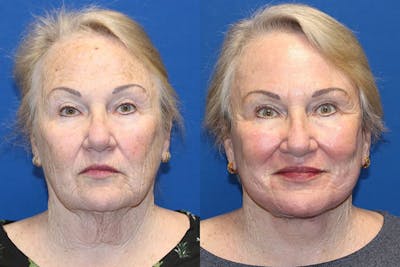 Laser Before & After Gallery - Patient 71701840 - Image 1