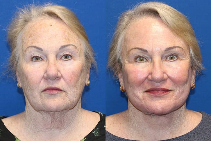 Laser Before & After Gallery - Patient 71701840 - Image 1