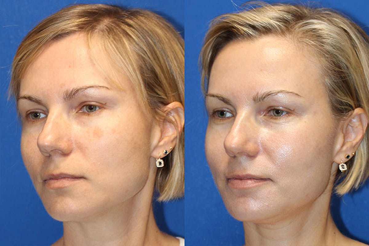 Halo Laser Before & After Gallery - Patient 71701825 - Image 3