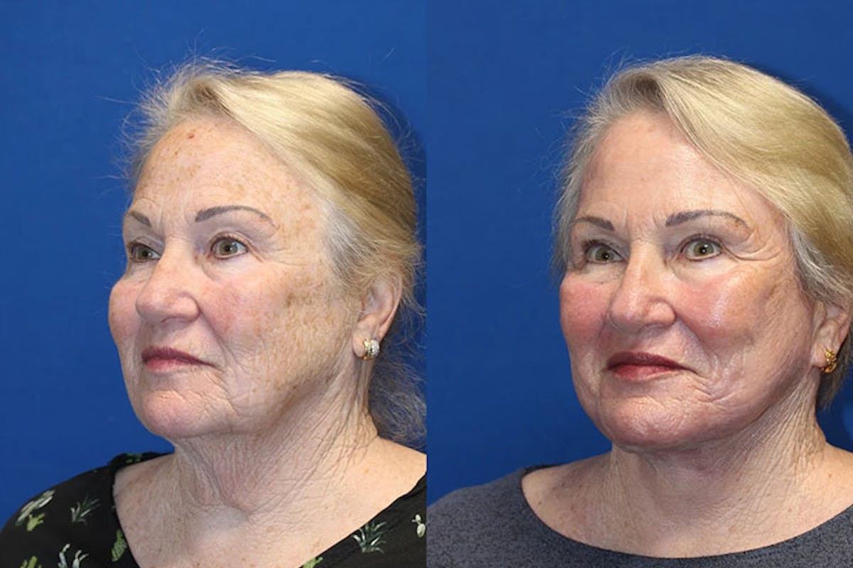 Laser Before & After Gallery - Patient 71701840 - Image 2