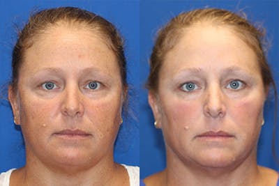 BBL Laser Before & After Gallery - Patient 71701827 - Image 1