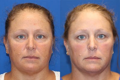 BBL Laser Before & After Gallery - Patient 71701827 - Image 1