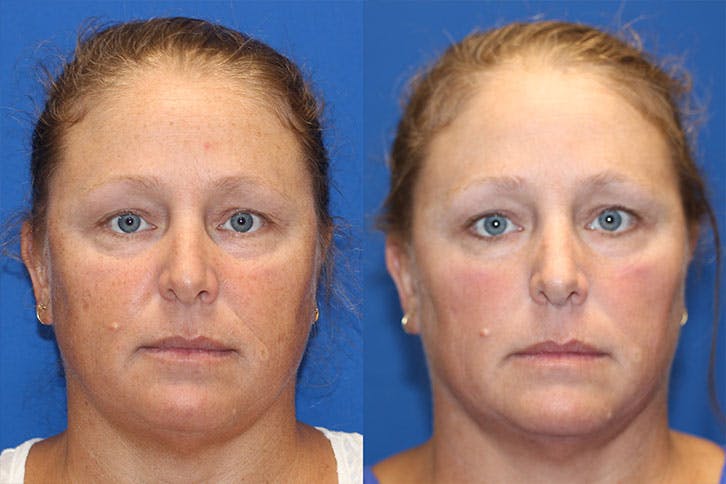 BBL Laser Before & After Gallery - Patient 71701827 - Image 1