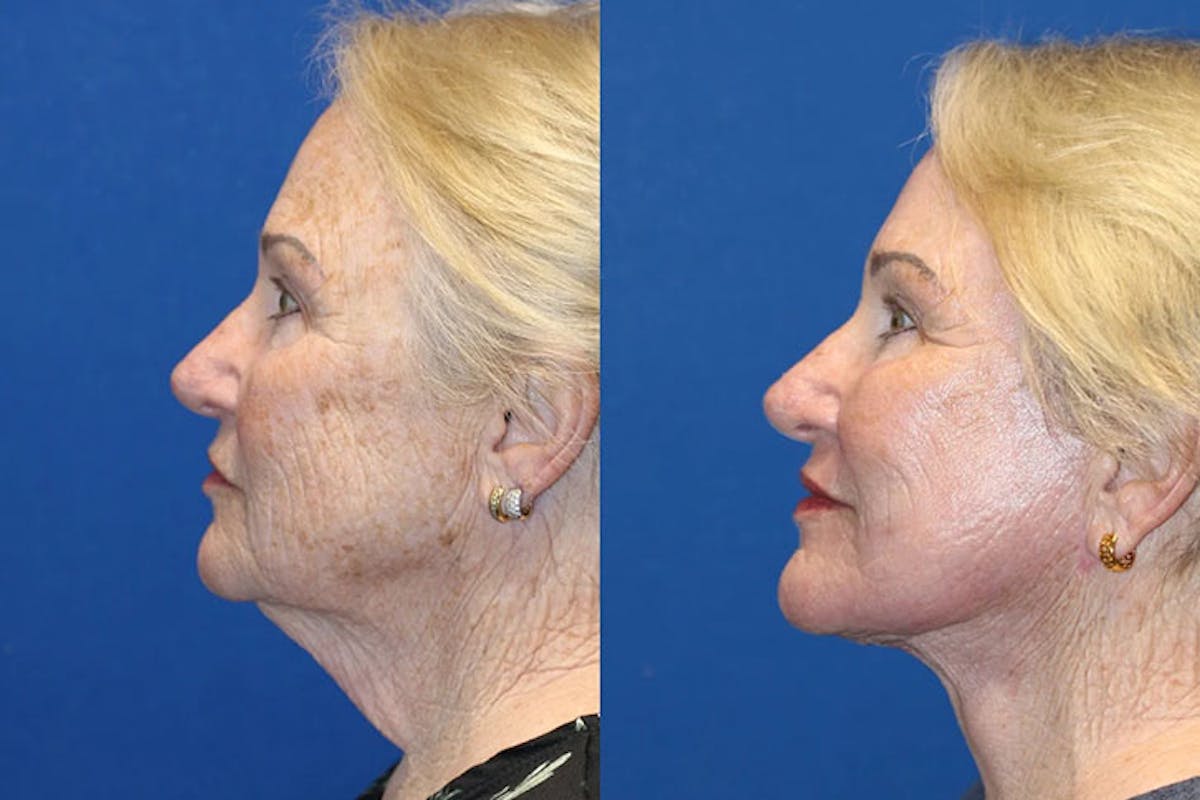 Laser Before & After Gallery - Patient 71701840 - Image 3