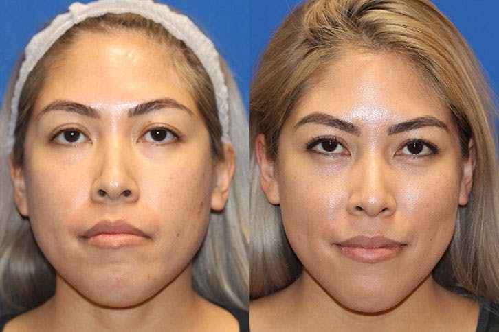 Halo Laser Before & After Gallery - Patient 71701828 - Image 1