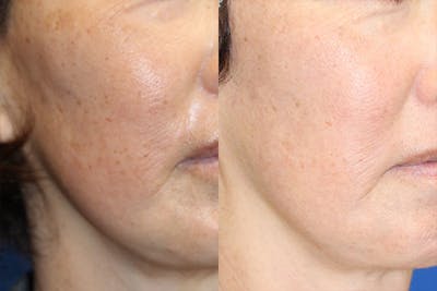 Halo Laser Before & After Gallery - Patient 71701834 - Image 1