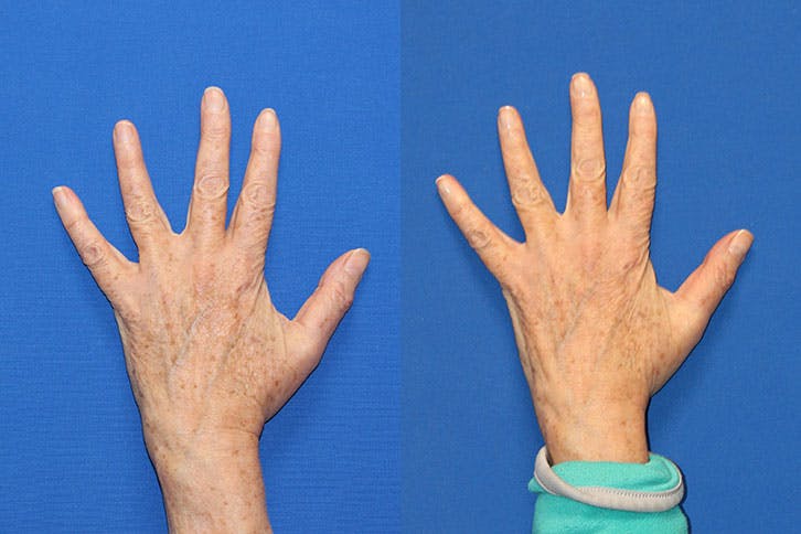 BBL Laser Before & After Gallery - Patient 71701835 - Image 2