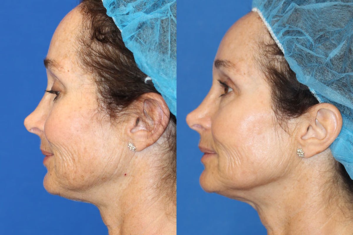 BBL Laser Before & After Gallery - Patient 71701836 - Image 1