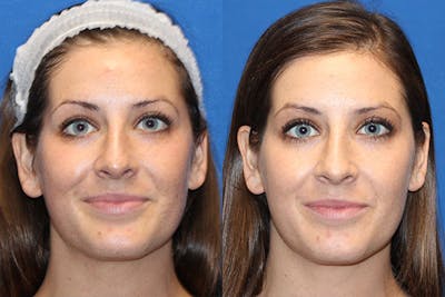 BBL Laser Before & After Gallery - Patient 71701837 - Image 1