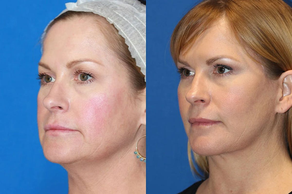 Laser Before & After Gallery - Patient 71701842 - Image 2