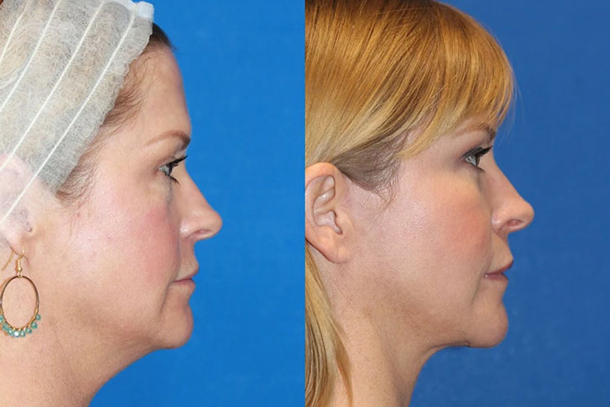 Laser Before & After Gallery - Patient 71701842 - Image 3