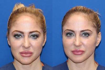 Laser Before & After Gallery - Patient 71701845 - Image 1