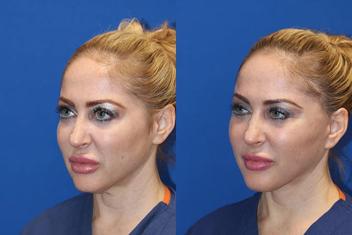 Laser Before & After Gallery - Patient 71701845 - Image 2
