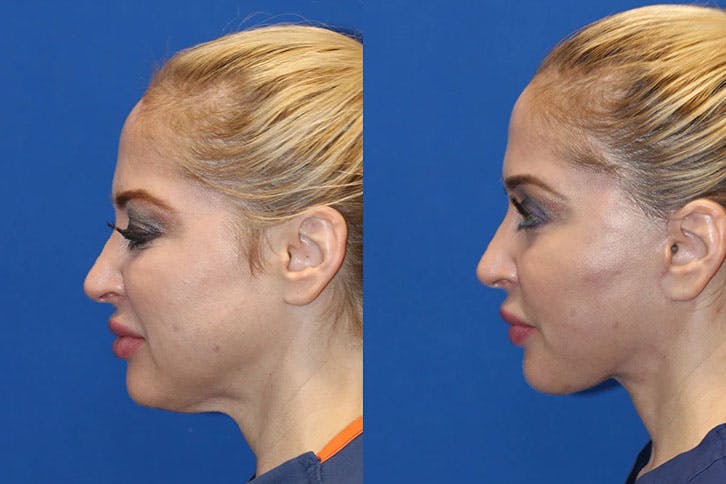 Laser Before & After Gallery - Patient 71701845 - Image 3