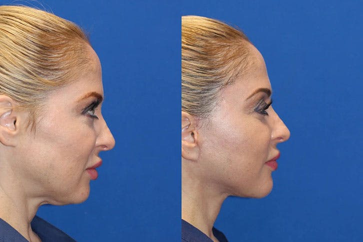 Laser Before & After Gallery - Patient 71701845 - Image 4