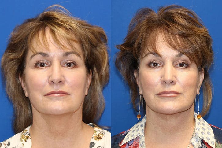 Laser Before & After Gallery - Patient 71701847 - Image 1