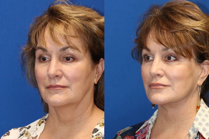 Laser Before & After Gallery - Patient 71701847 - Image 2