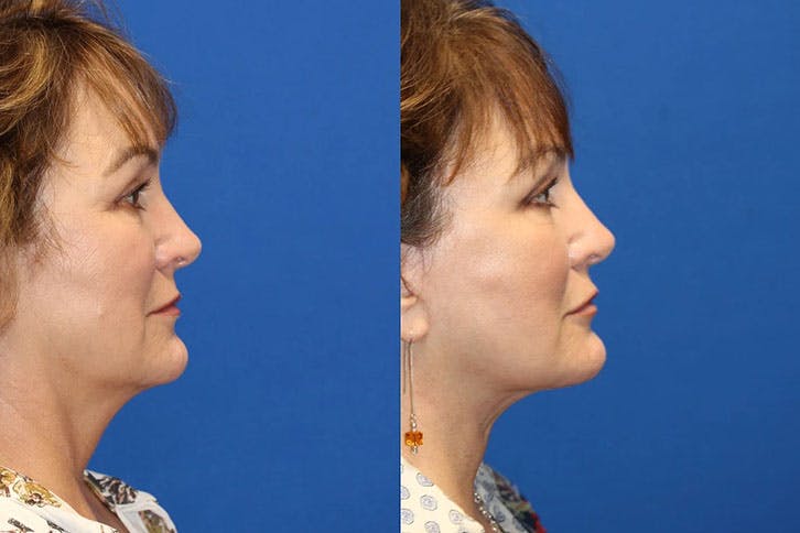 Laser Before & After Gallery - Patient 71701847 - Image 3