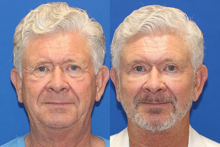 Laser Before & After Gallery - Patient 71701850 - Image 1