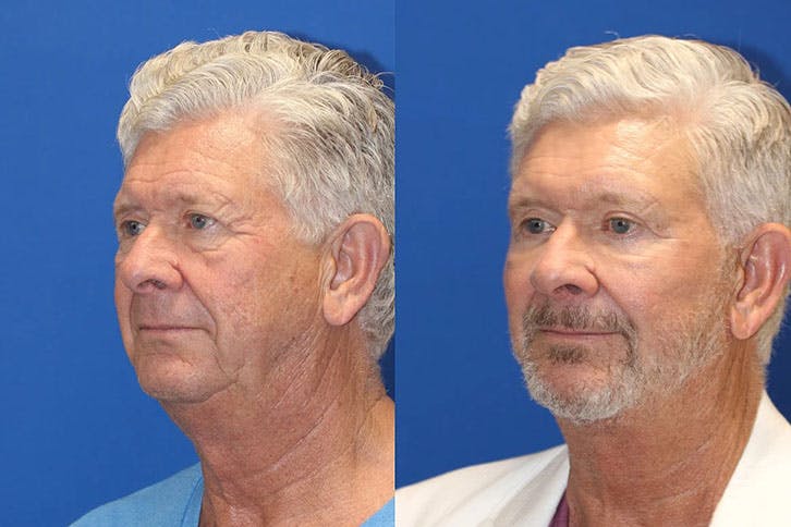 Laser Before & After Gallery - Patient 71701850 - Image 2