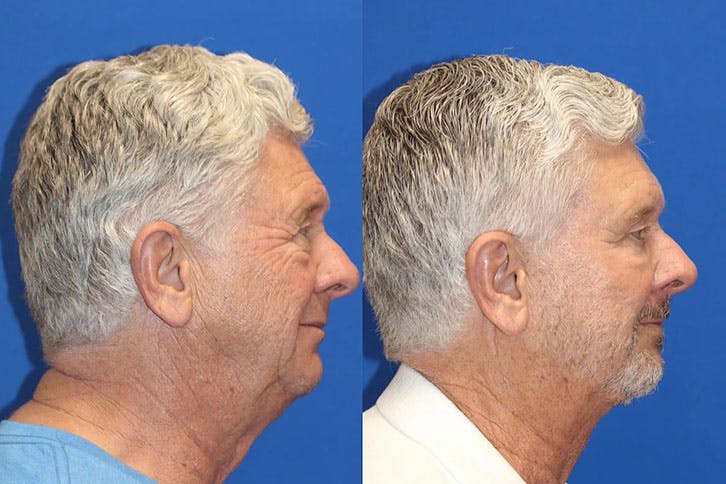 Laser Before & After Gallery - Patient 71701850 - Image 3