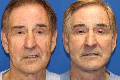 Laser Before & After Gallery - Patient 71701852 - Image 1
