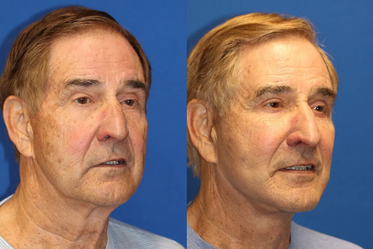 Laser Before & After Gallery - Patient 71701852 - Image 2