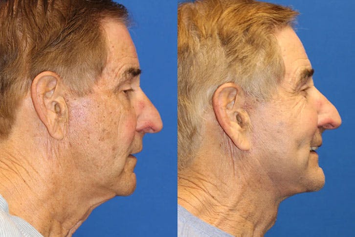Laser Before & After Gallery - Patient 71701852 - Image 3