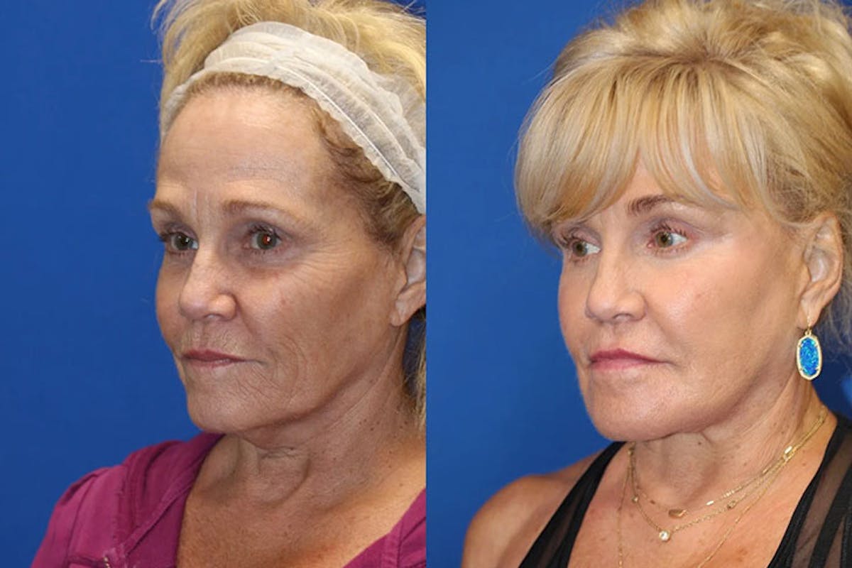 Laser Before & After Gallery - Patient 71701867 - Image 2