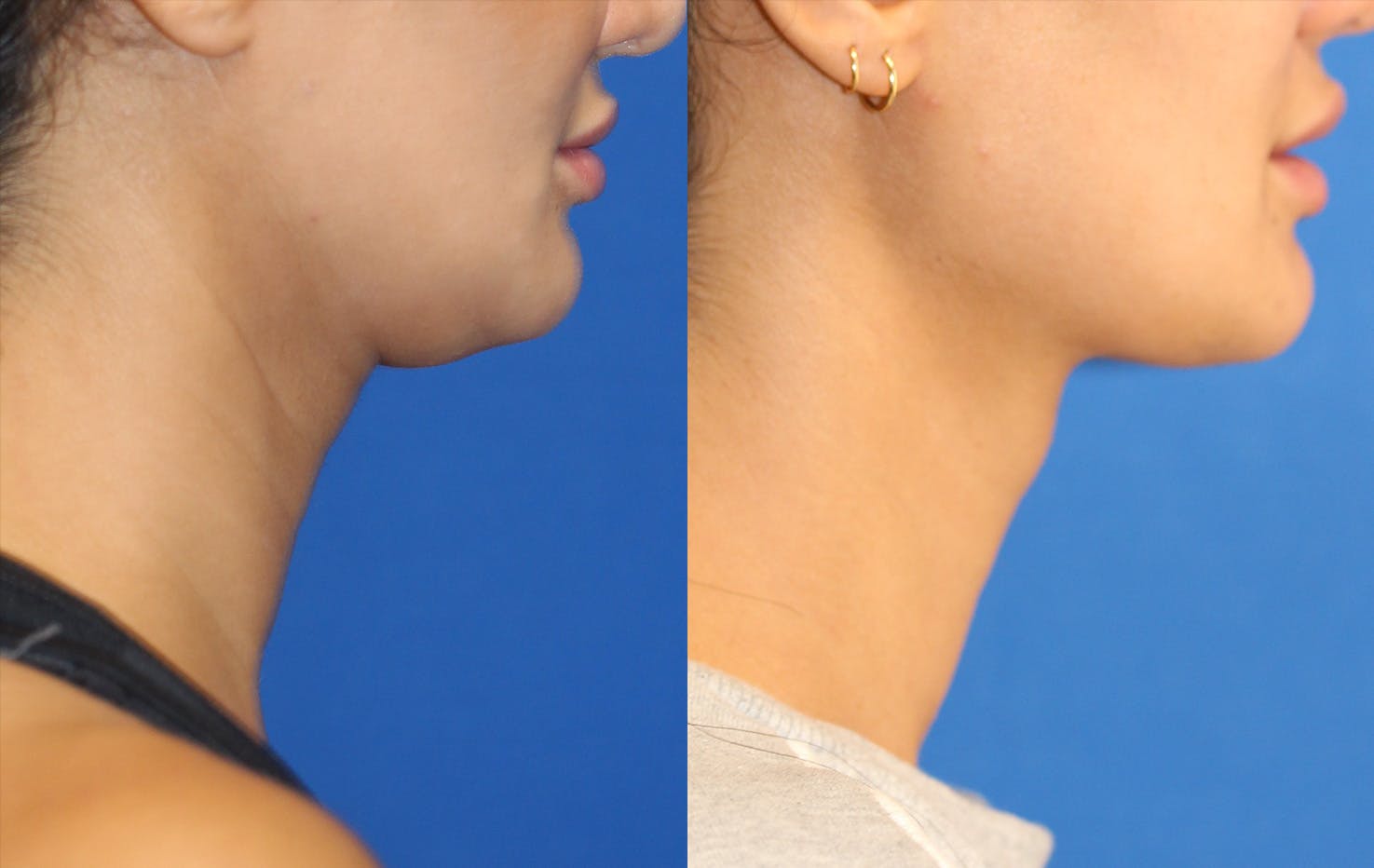 Kybella