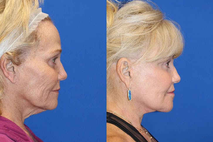 Laser Before & After Gallery - Patient 71701867 - Image 3