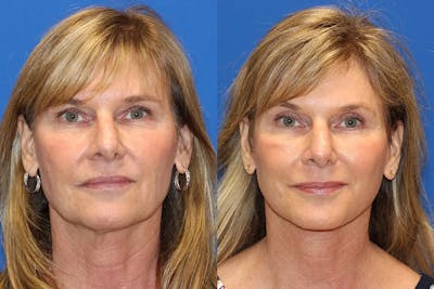 Laser Before & After Gallery - Patient 71701872 - Image 1